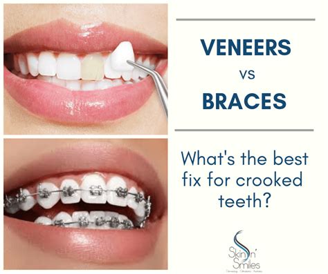Achieve a Straighter Smile in Minutes with Magic Teeth Brace Veneers